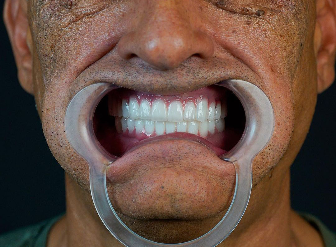 all on 4 impianti dentali all on 4 impianti dentali