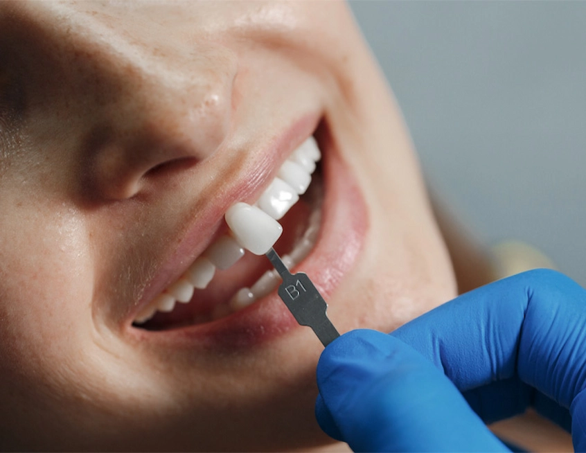 dental crowns