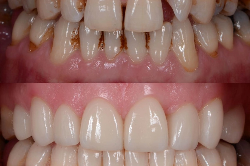 Zahnveneers