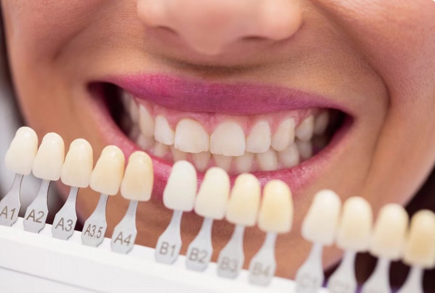verschiedene Arten von Zahnveneers