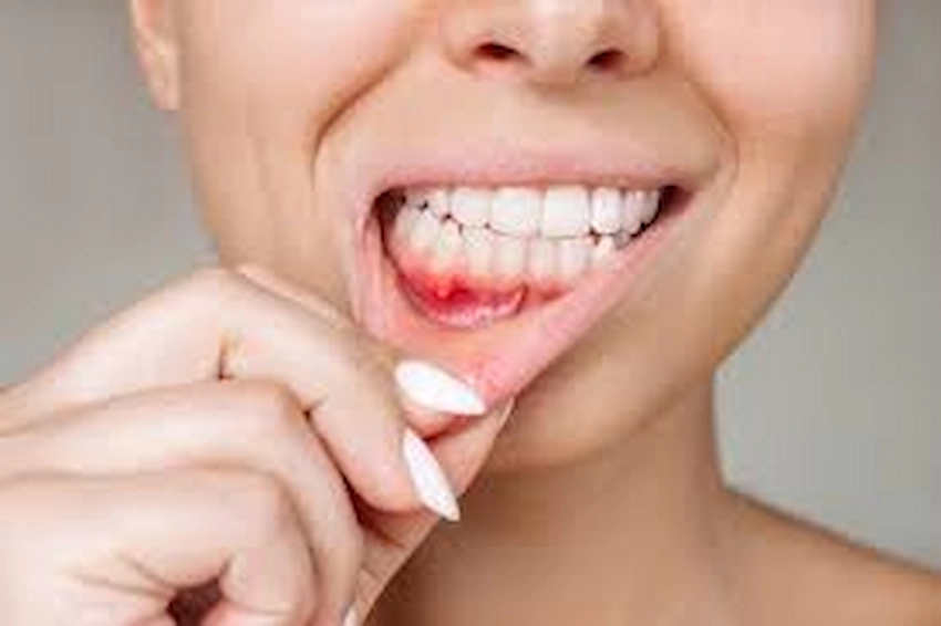 gum disease 1