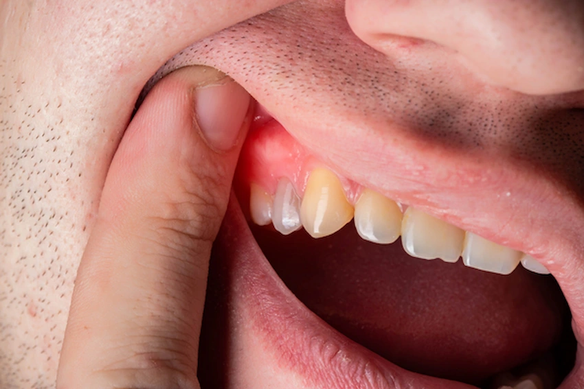 gum disease