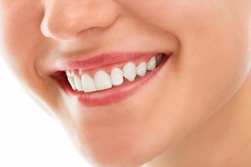 gummy smile nedir