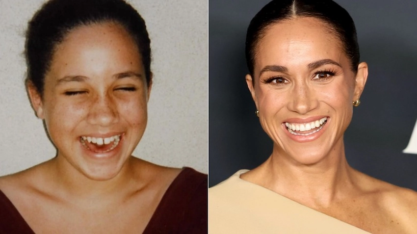 meghan markles teeth before