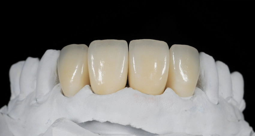 zirconia crown