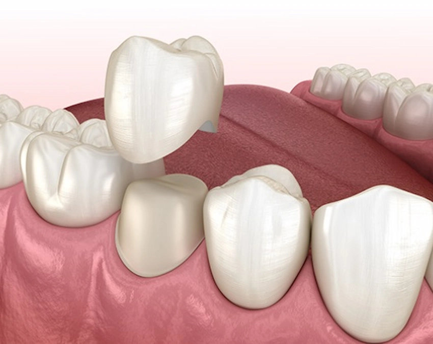 corona dentale