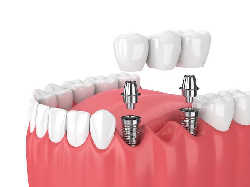 dental implant treatment