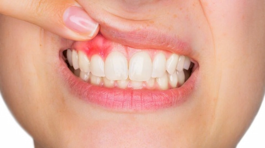 gum