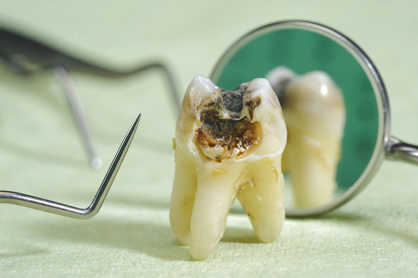 dents pourries