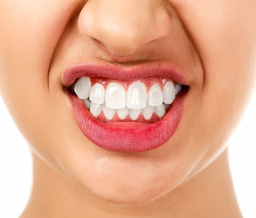 tratamente bruxism