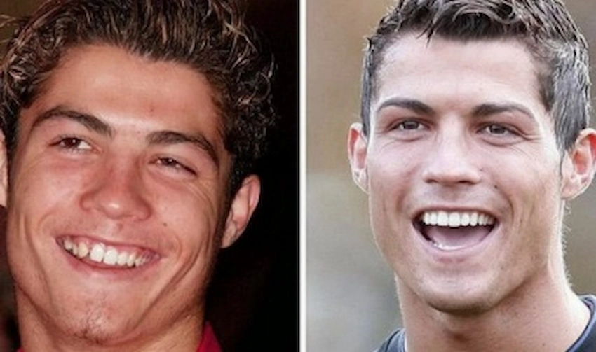 dientes de cristiano ronaldo