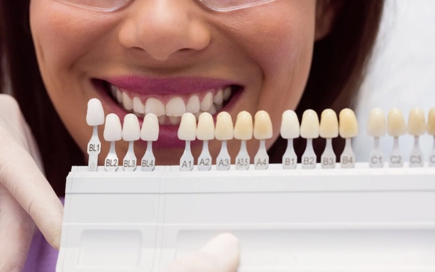 Zahnveneers Behandlung