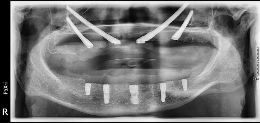 implants zygomatiques à istanbul turquie