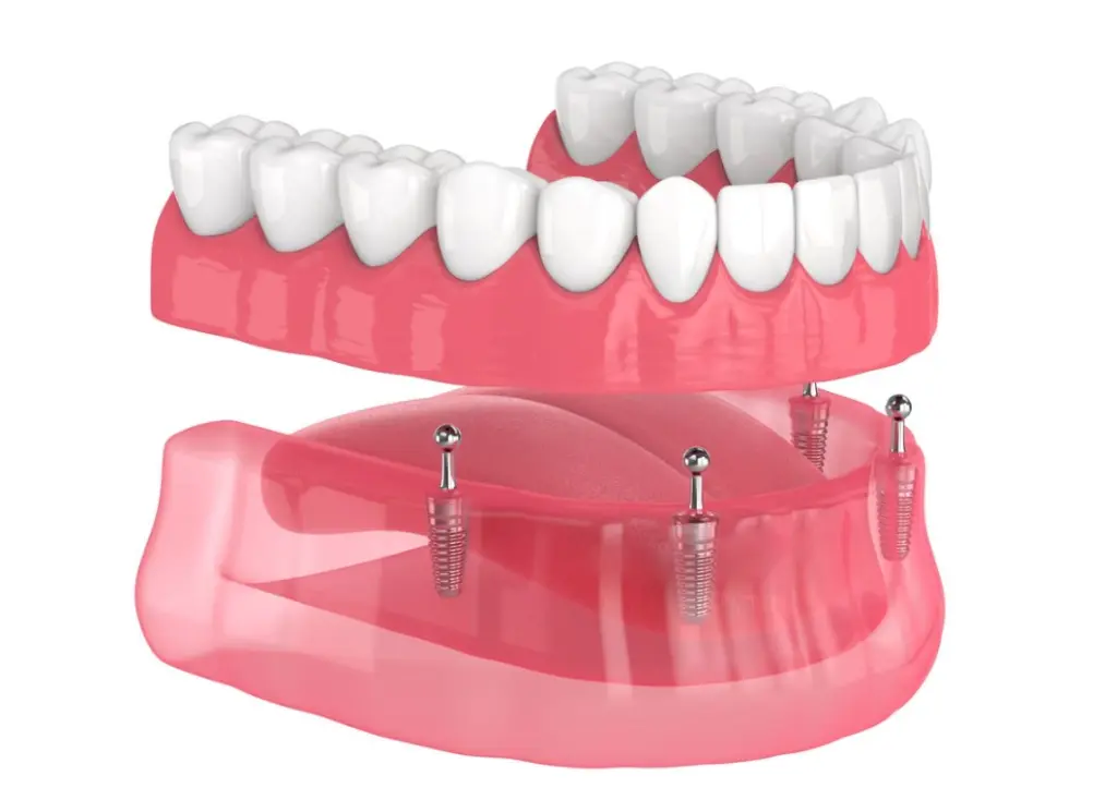 Mini Dental Implants