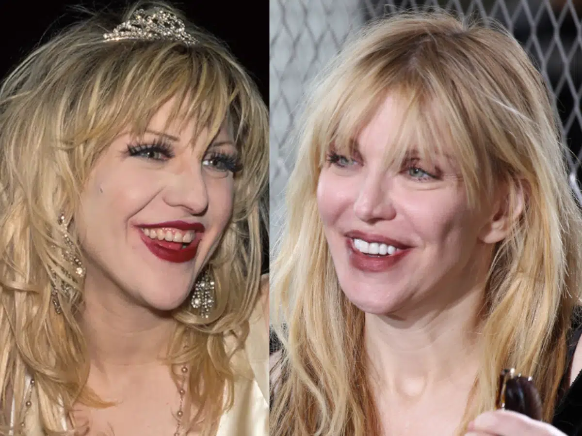 courtney love teeth before after