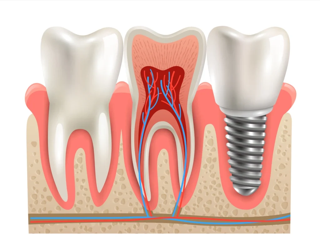 dental implants cost