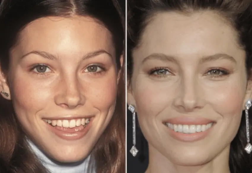 jessica biel teeth transformation