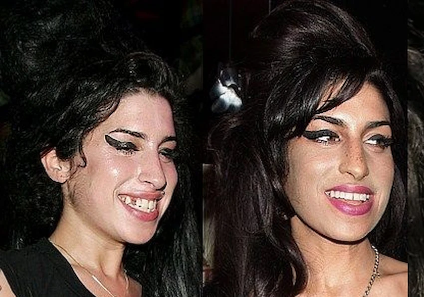 amy winehouse teeth