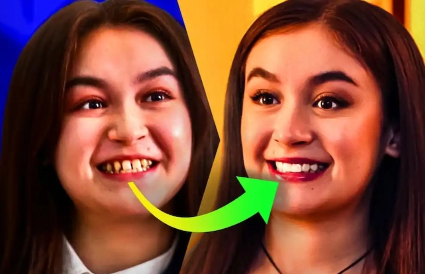 anna catchart teeth