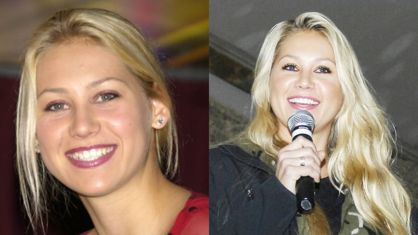 anna kournikova teeth before after