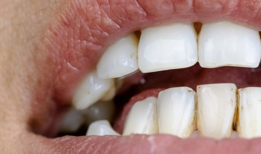 black stains teeth treatment