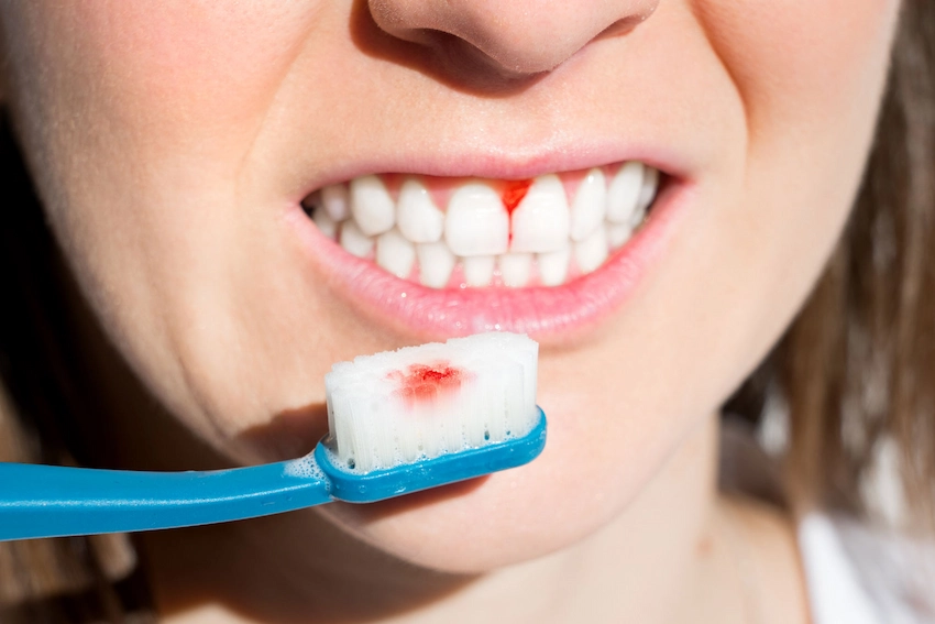 bleeding gums