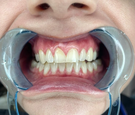 child teeth in close up
