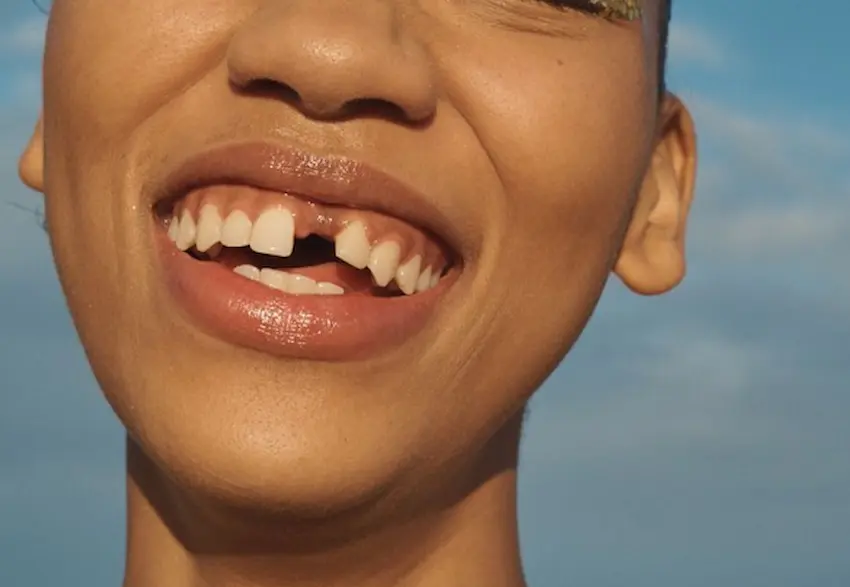 crooked teeth