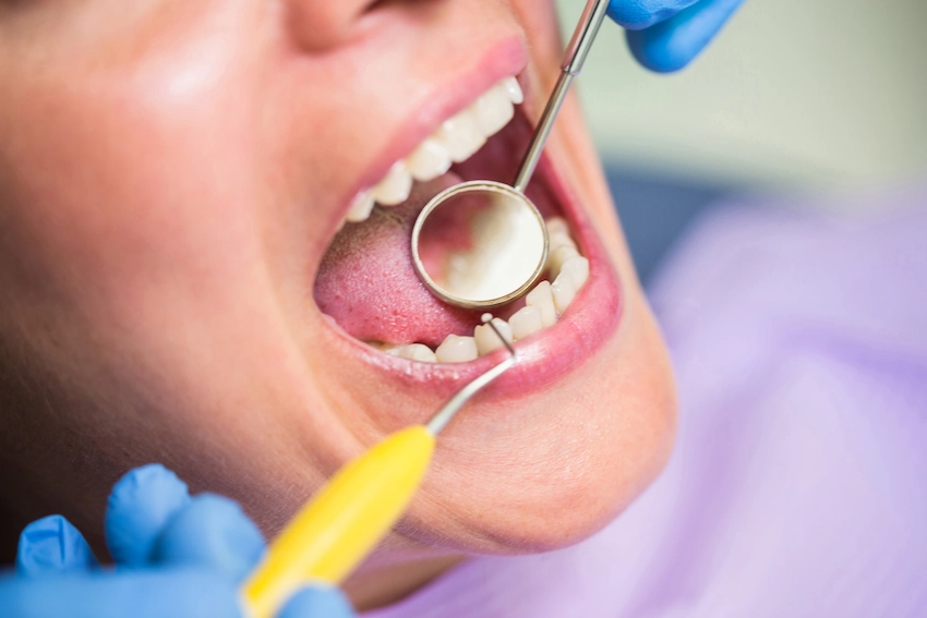 dental cyst