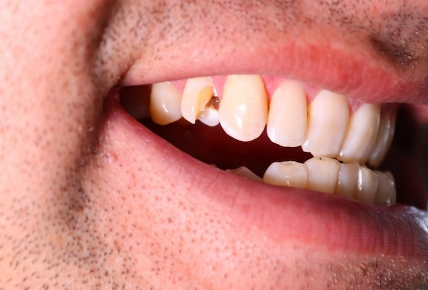 dental trauma
