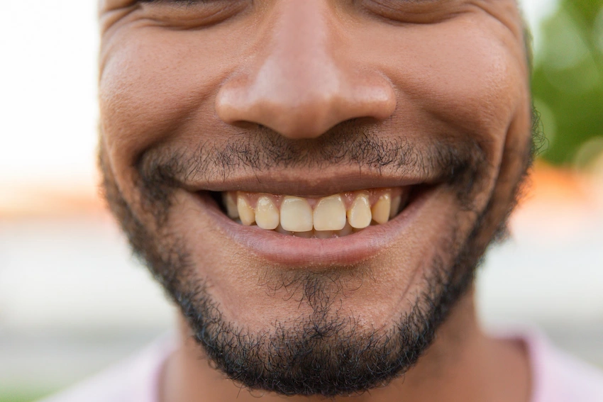 enamel abrasion