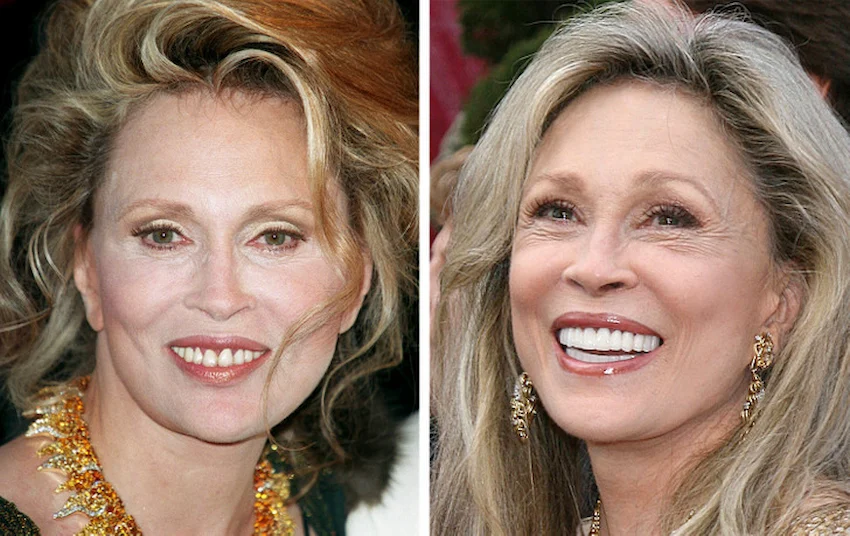 faye dunaway teeth before after