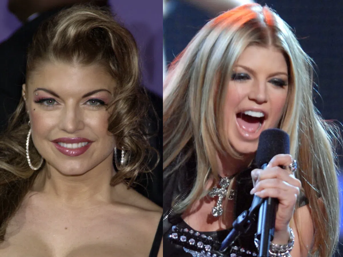fergie teeth before after