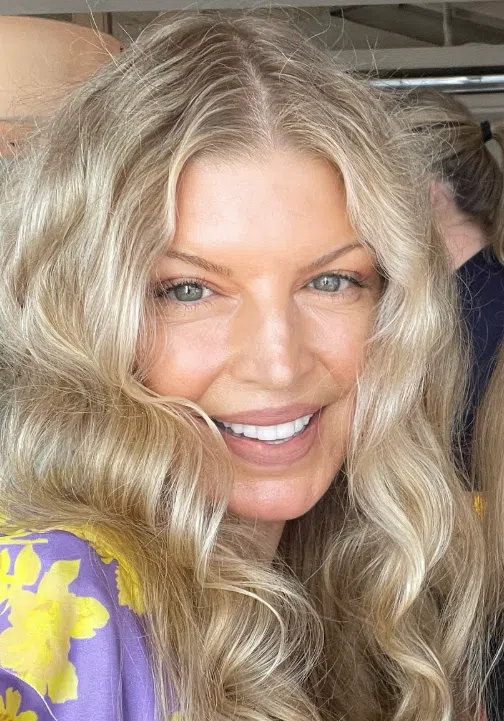 fergie teeth in 2025