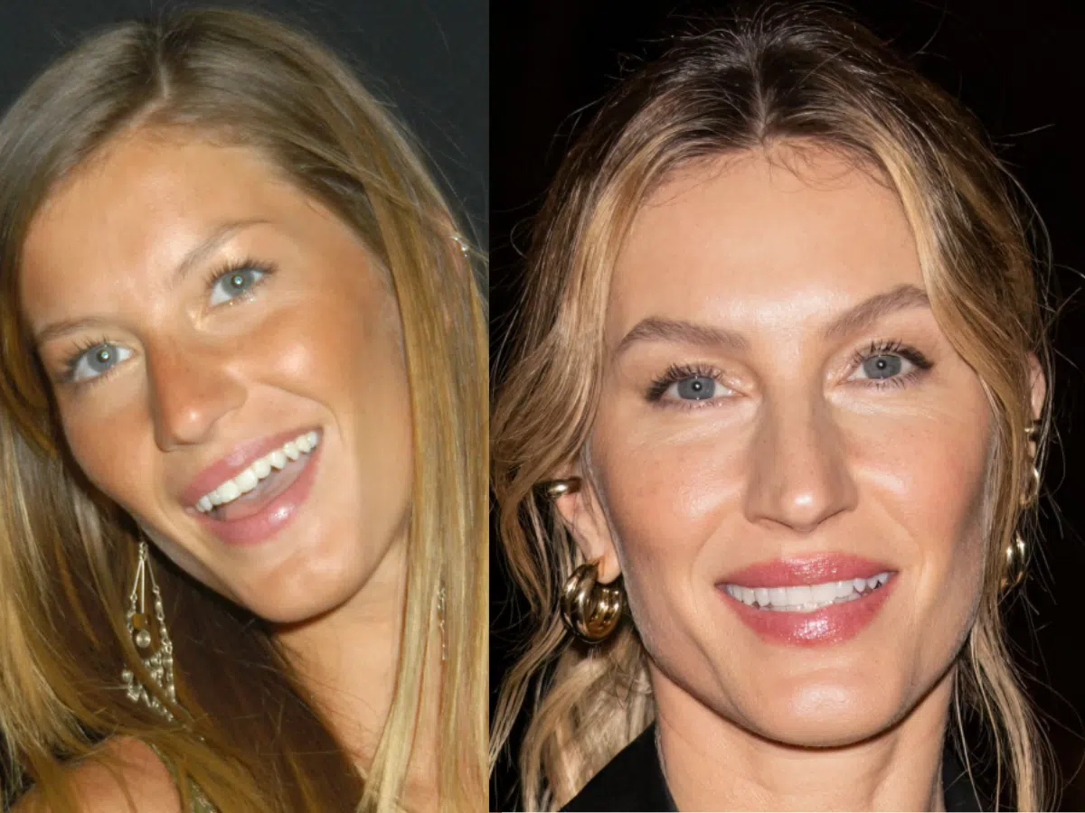 gisele bündchen teeth before after