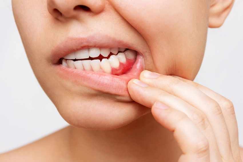 gum recession