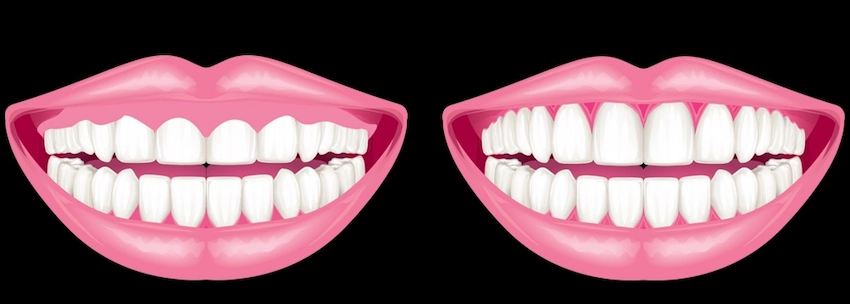 gums extend over