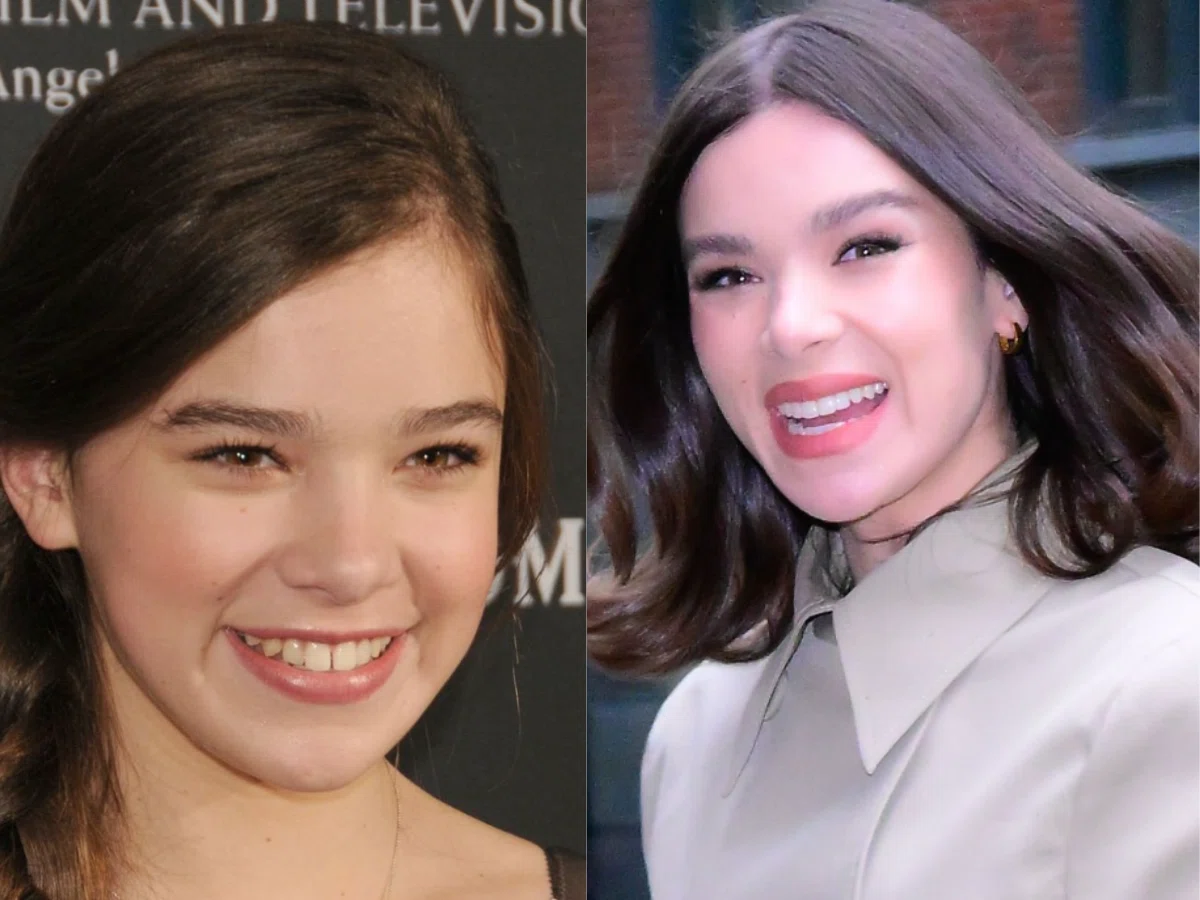 hailee steinfeld teeth before after
