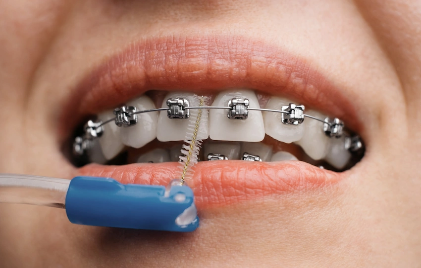 how to treat crooked teeth