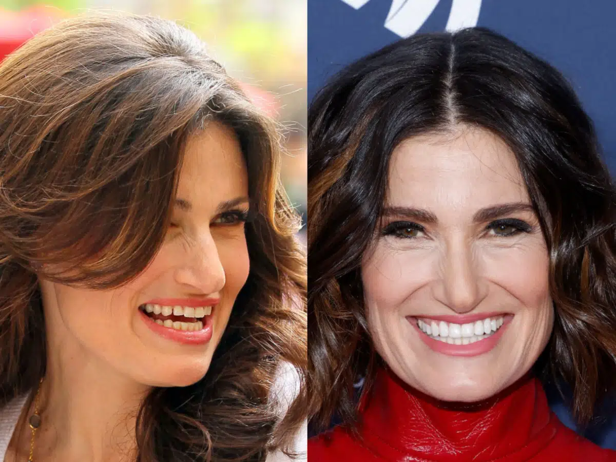 idina menzel teeth before after