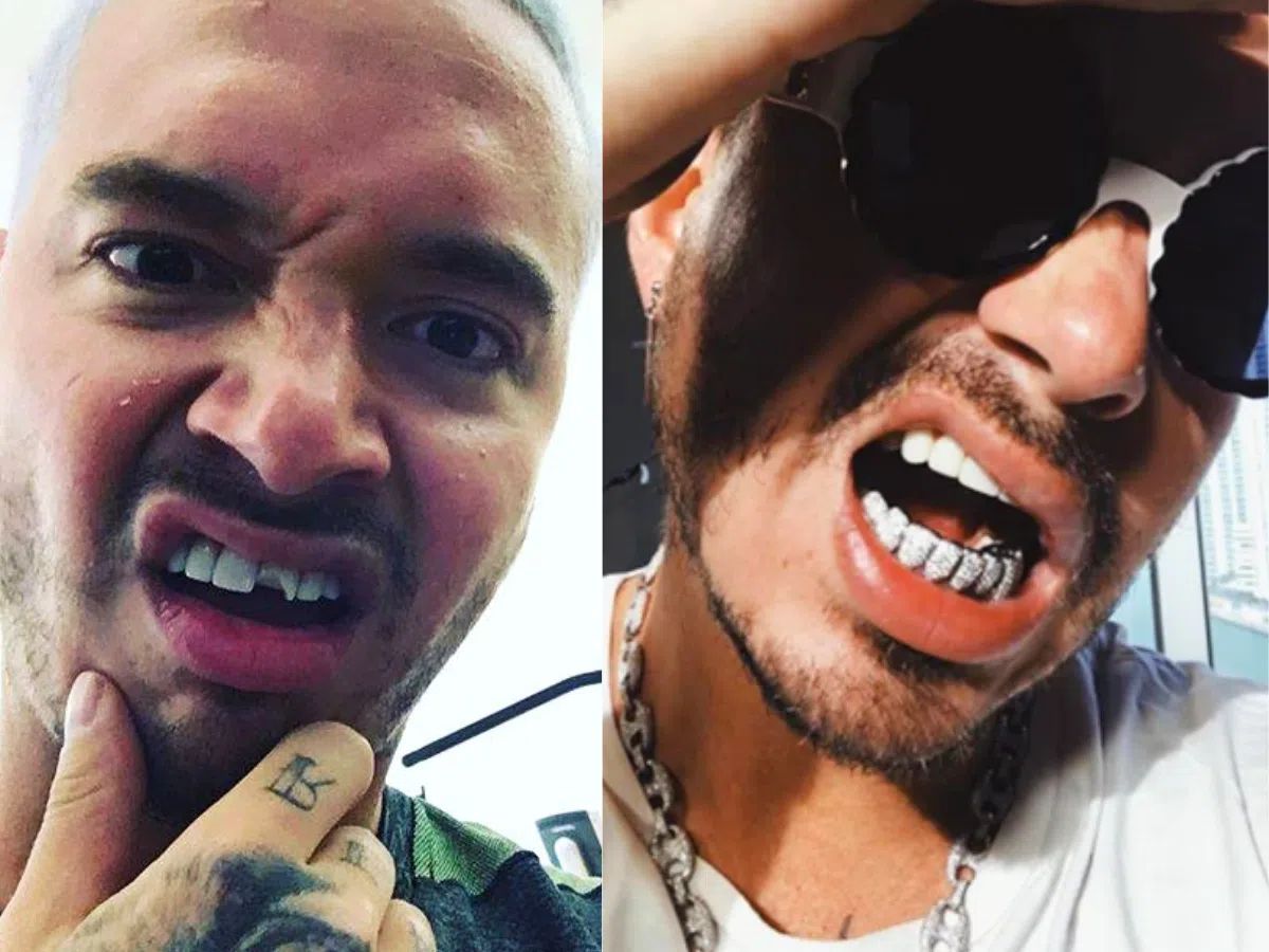 j balvin teeth before after