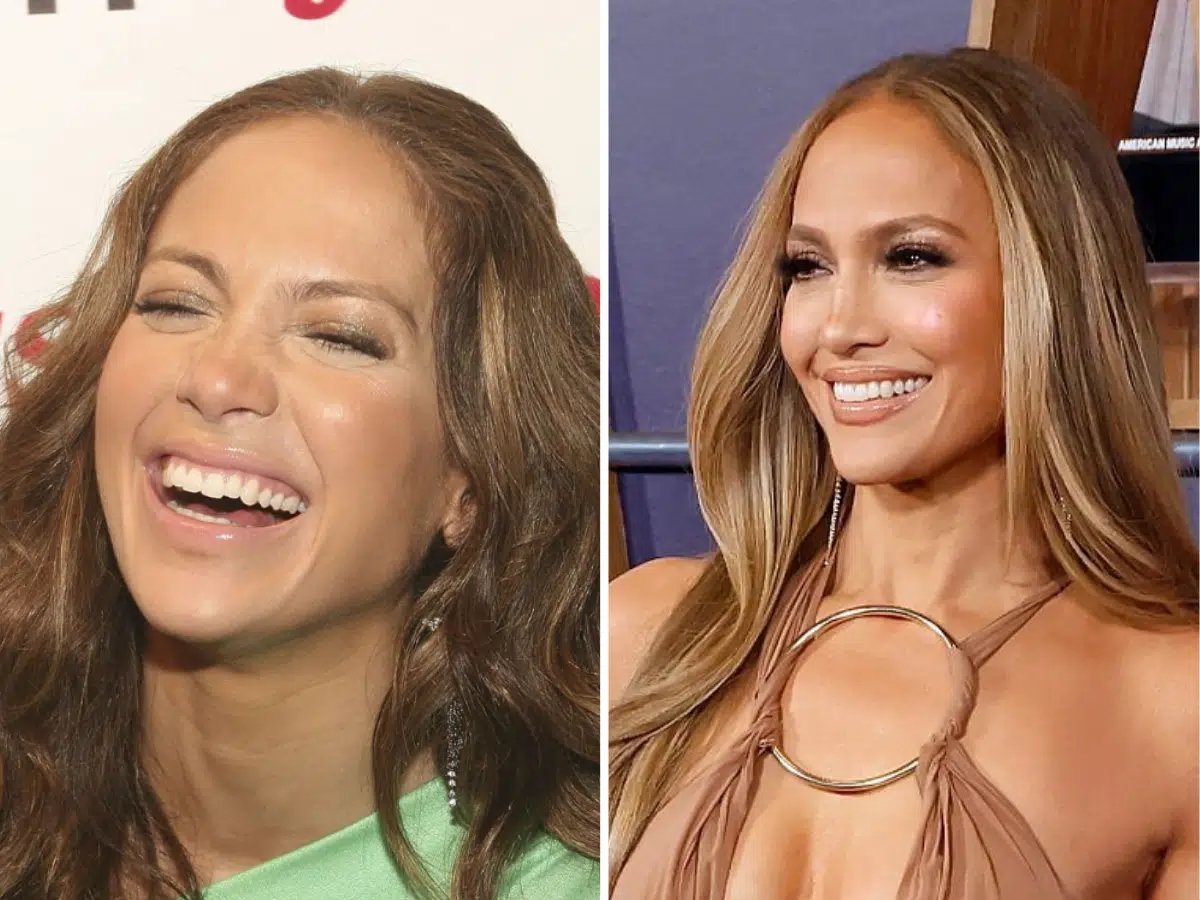 jennifer lopez teeth before after