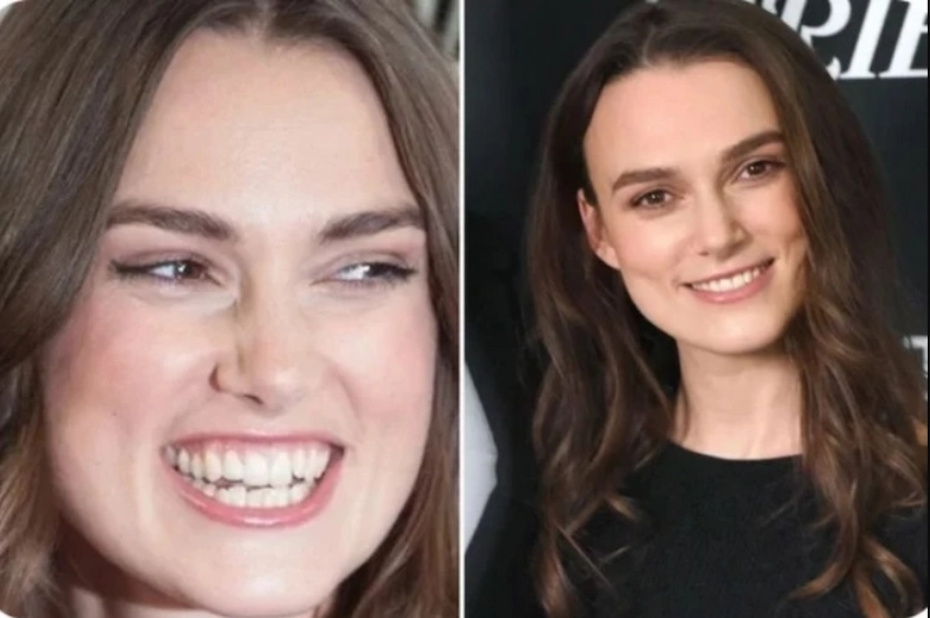kiera knightley teeth