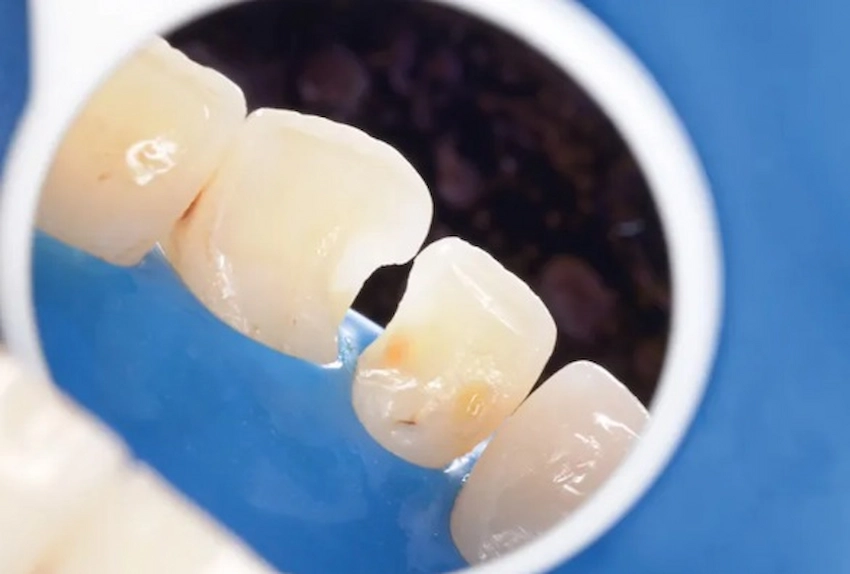 lateral cavity teeth