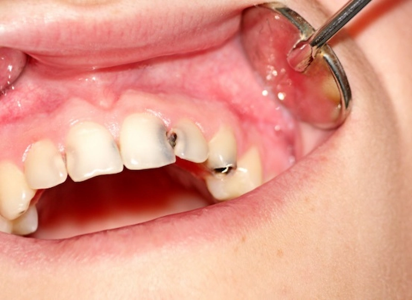 lateral cavity