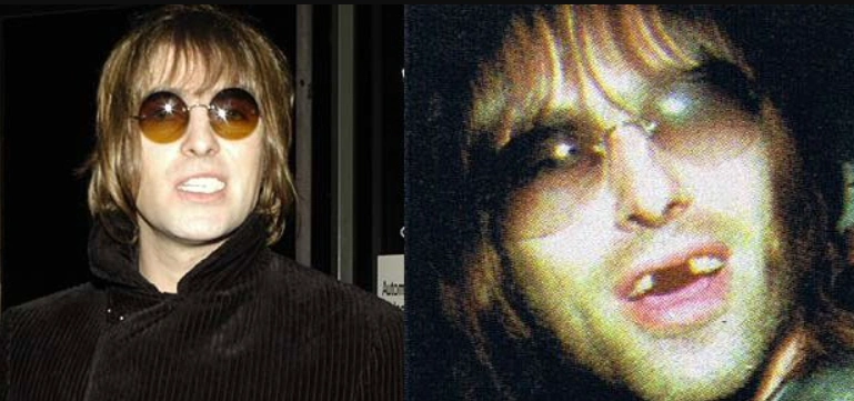 liam gallagher teeth knocked out