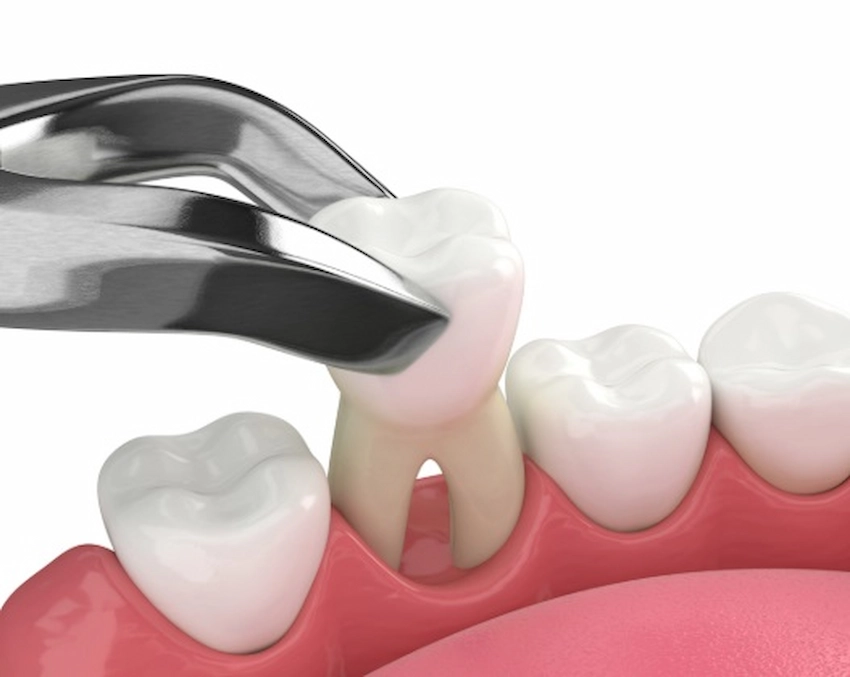 loosen teeth dentist