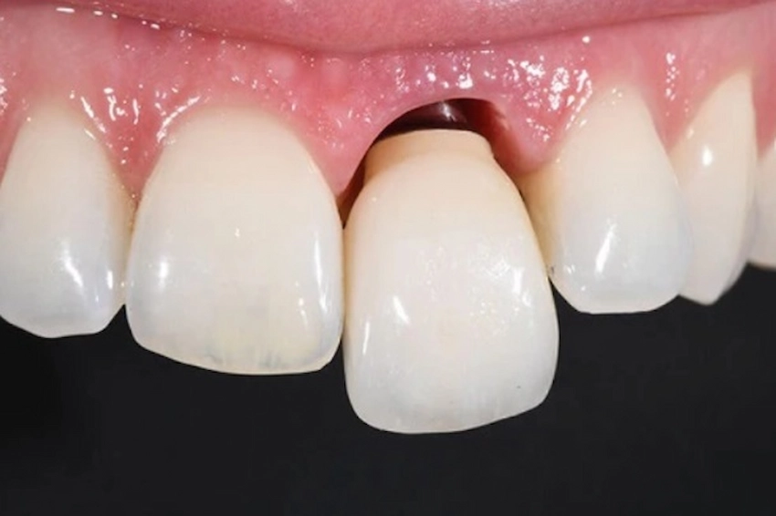 loosen teeth treatment