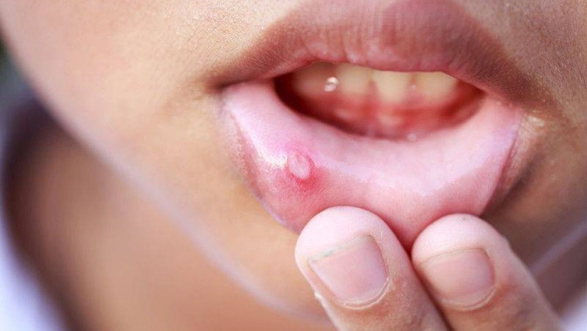 mouth irritations and ulcers