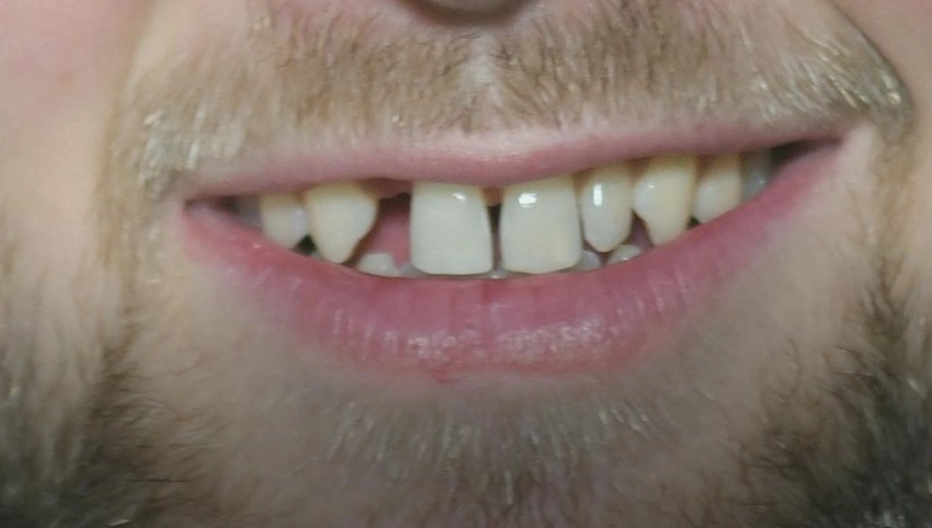 niclas füllkrug teeth